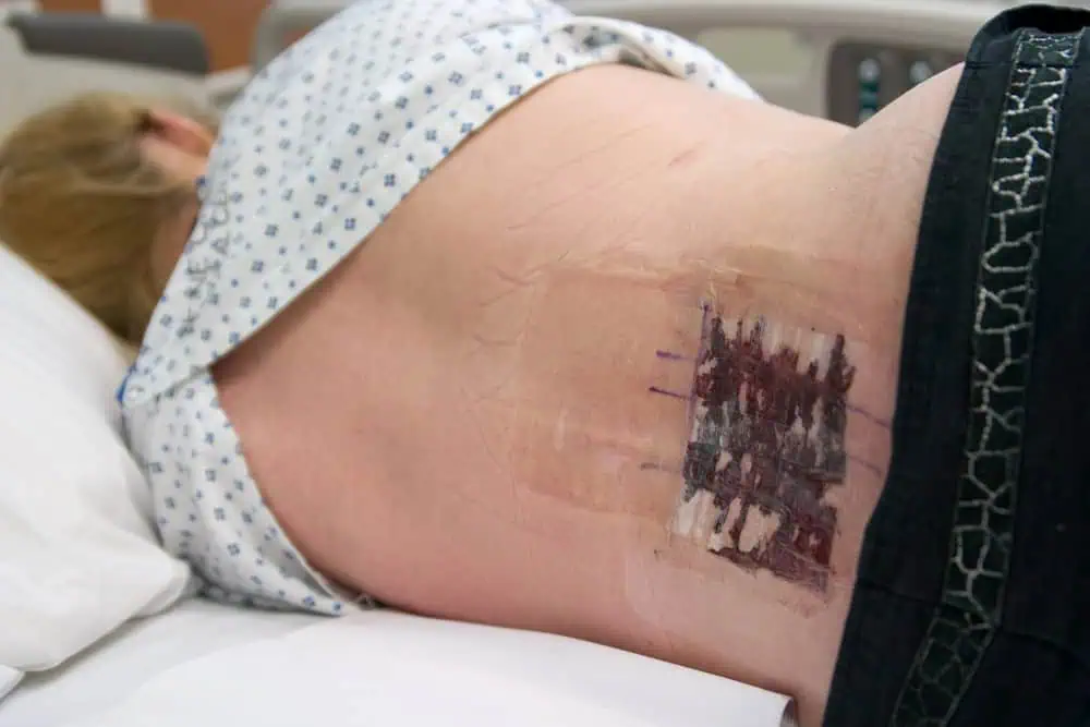 selective nerve root blocks
