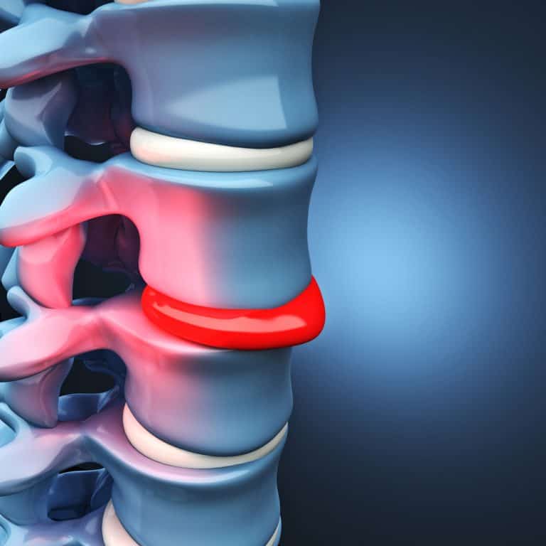 Vertiflex Procedure: A Minimally Invasive Solution for Lumbar Spinal ...