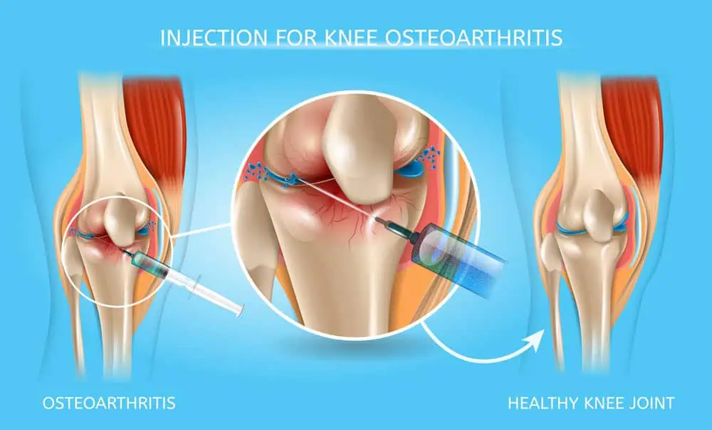 Joint injections