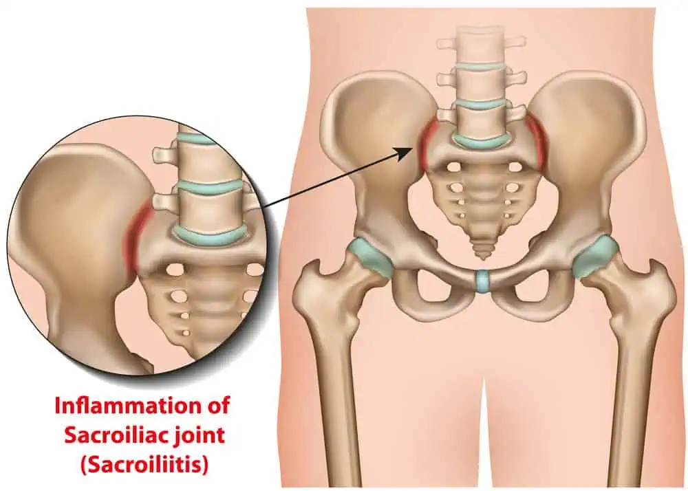 Sacroiliac Joint Fusion