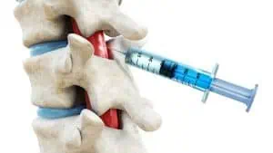 Epidural Injections