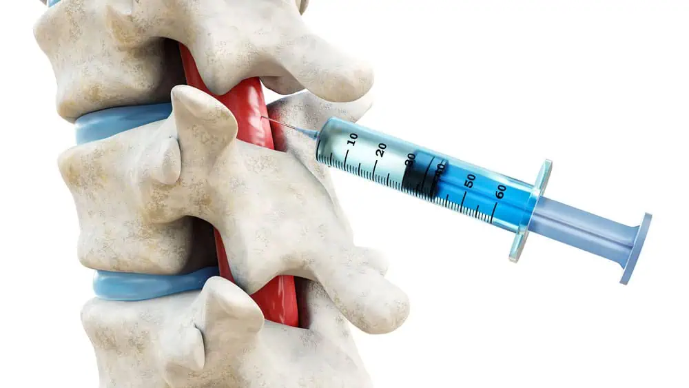 Epidural Injections