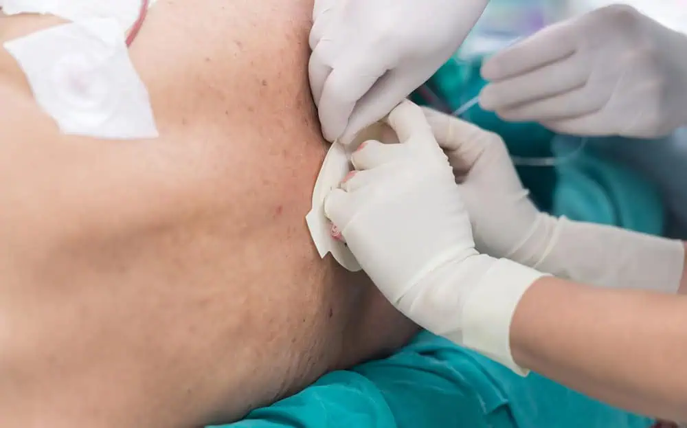 Epidural Injections