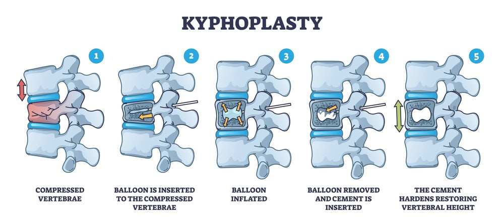 Vertebroplasty and Kyphoplasty