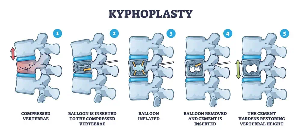 Vertebroplasty and Kyphoplasty