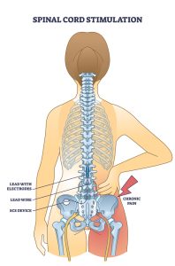 spinal cord stimulation