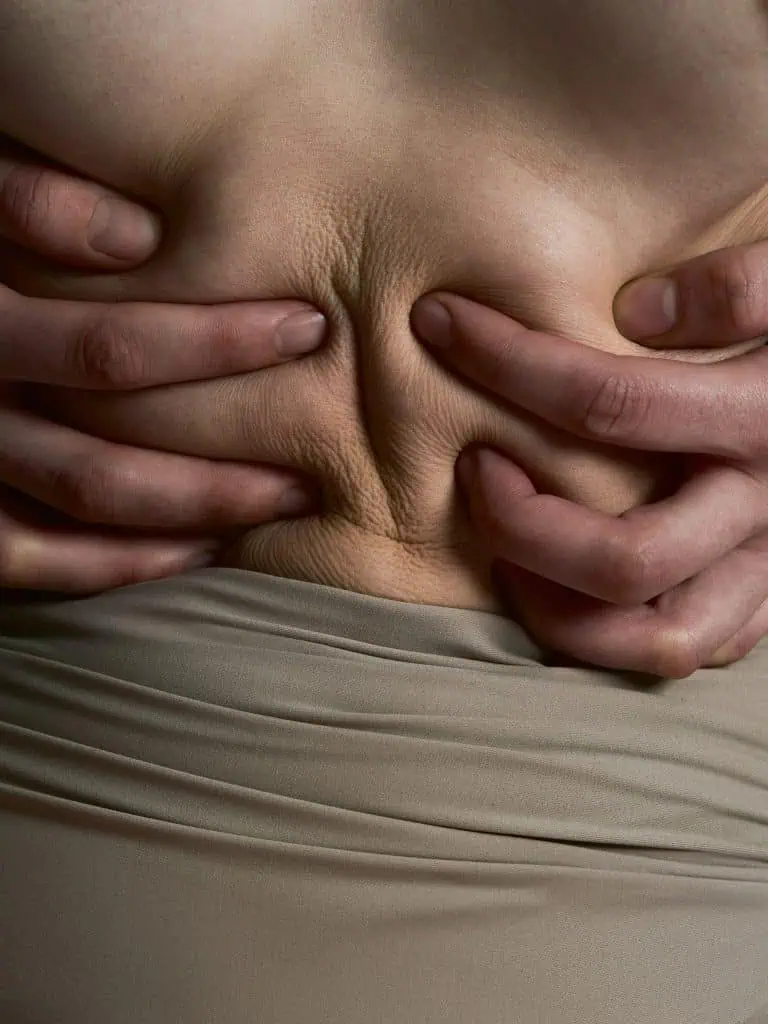 tighten skin after weight loss